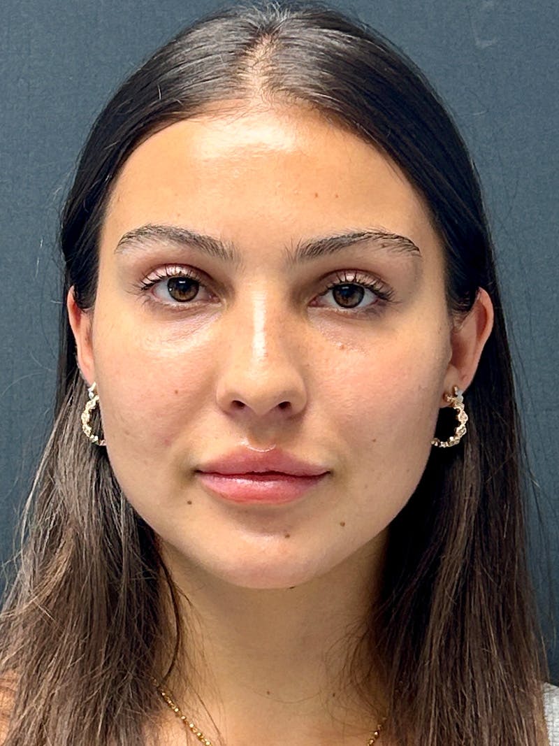 Primary Rhinoplasty Before & After Gallery - Patient 292088 - Image 3