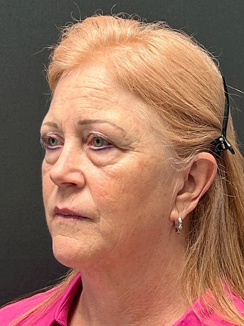 Facelift Before & After Gallery - Patient 104254 - Image 3