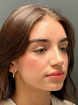 Primary Rhinoplasty Before & After Gallery - Patient 339573 - Image 6