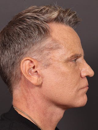 Blepharoplasty Before & After Gallery - Patient 322814 - Image 6