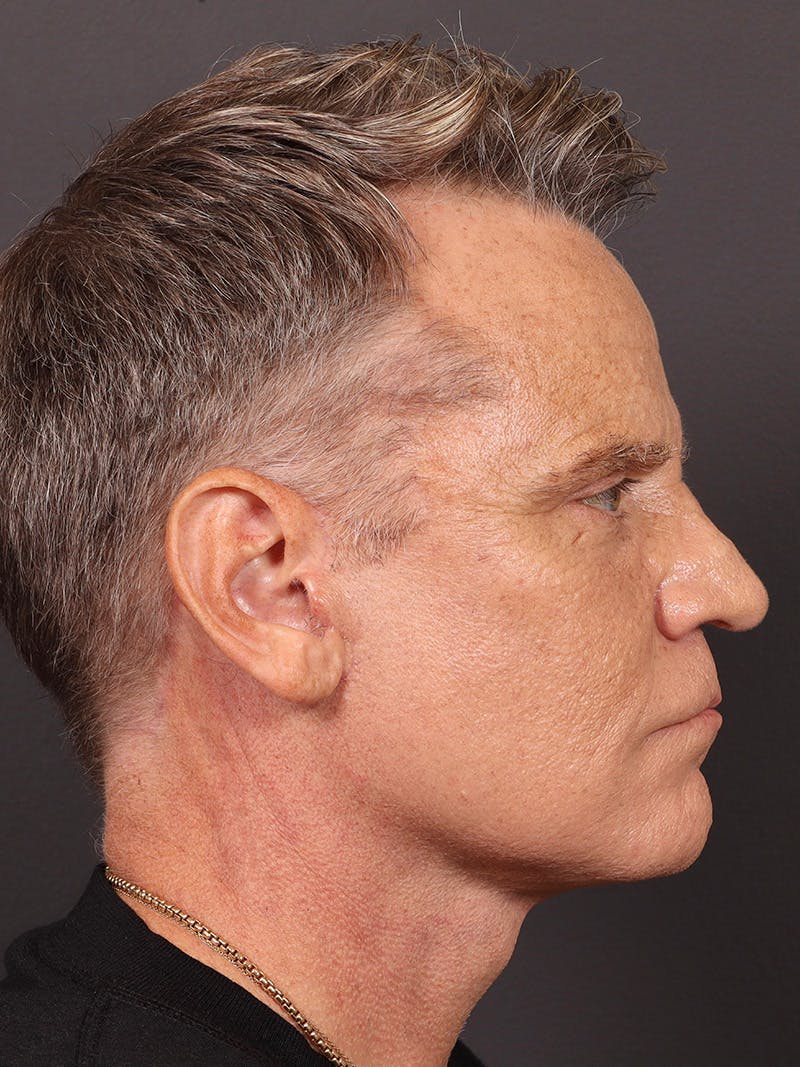Blepharoplasty Before & After Gallery - Patient 322814 - Image 6