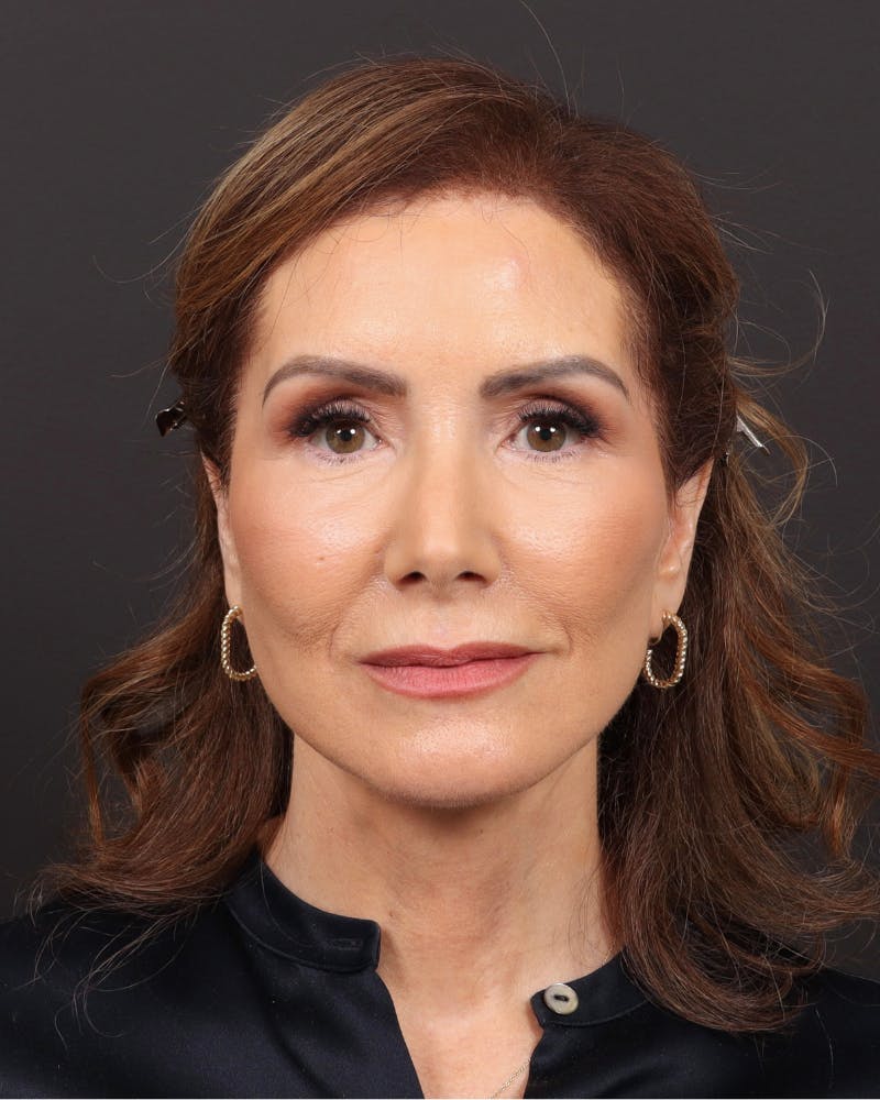 Facelift Before & After Gallery - Patient 839916 - Image 2