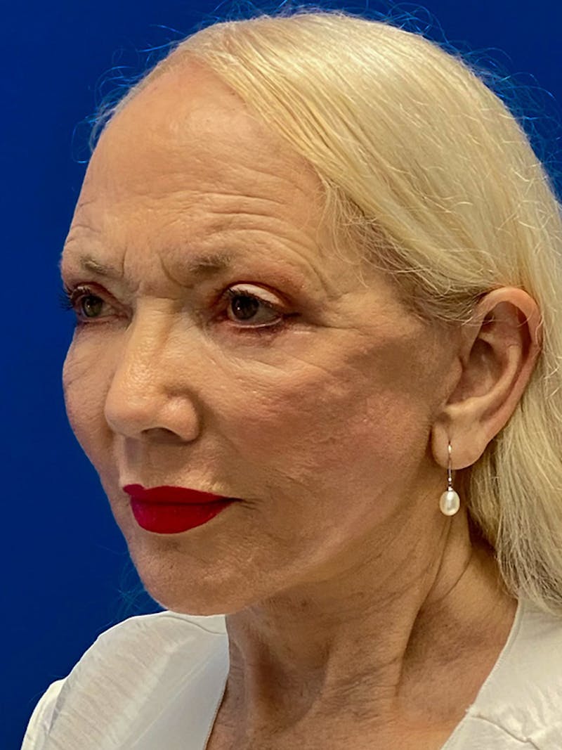 Facelift Before & After Gallery - Patient 326906 - Image 4