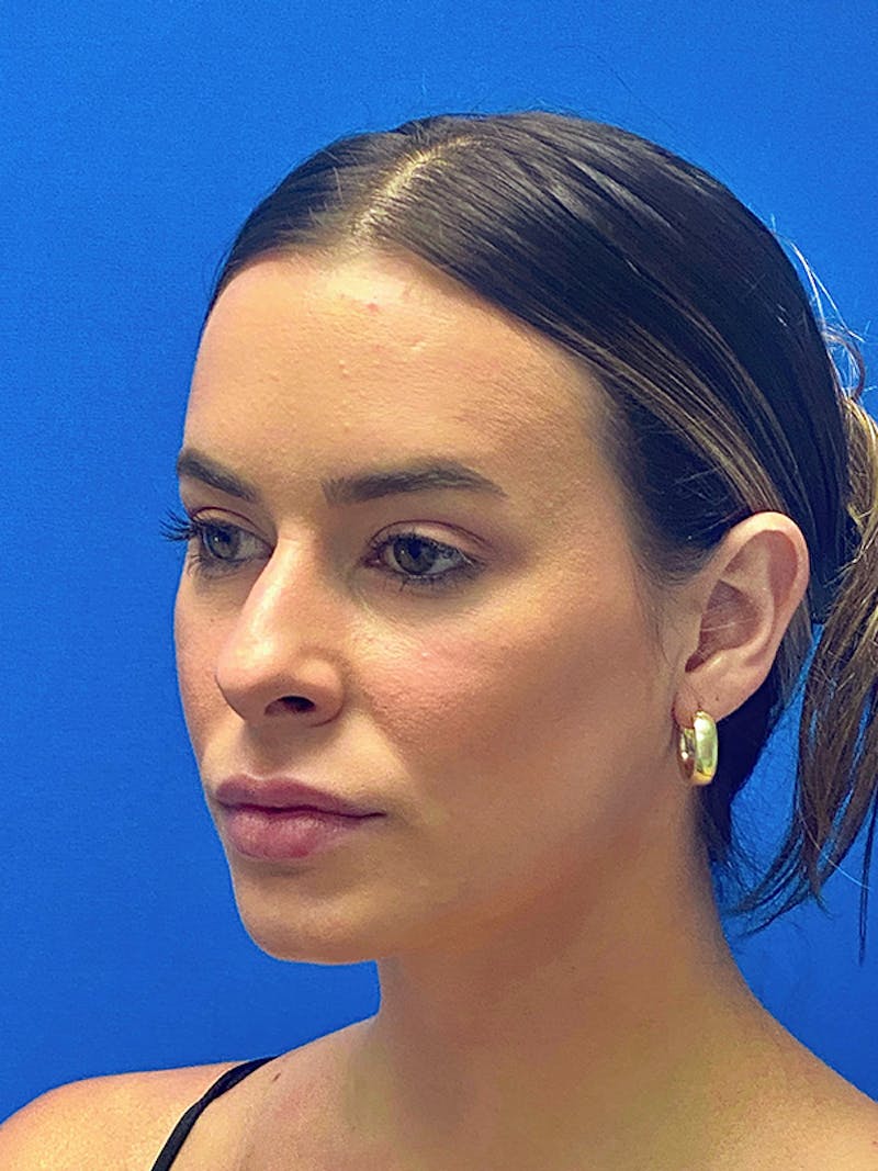 Primary Rhinoplasty Before & After Gallery - Patient 235266 - Image 5