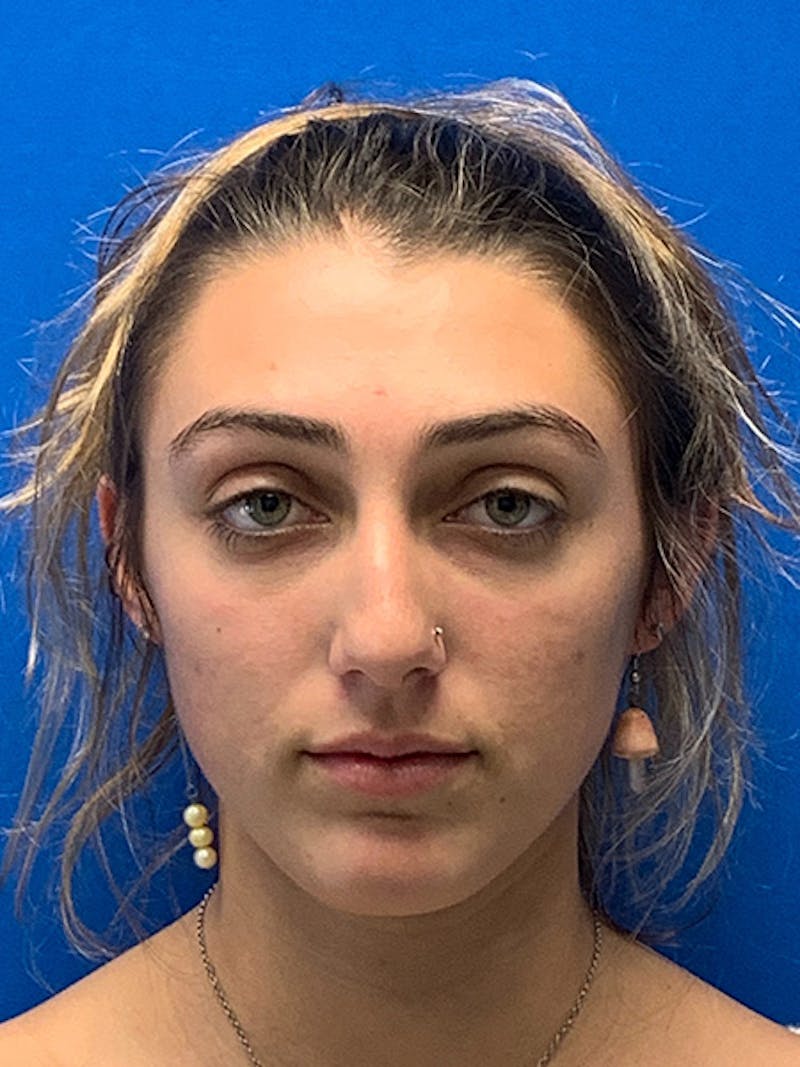 Primary Rhinoplasty Before & After Gallery - Patient 286346 - Image 3