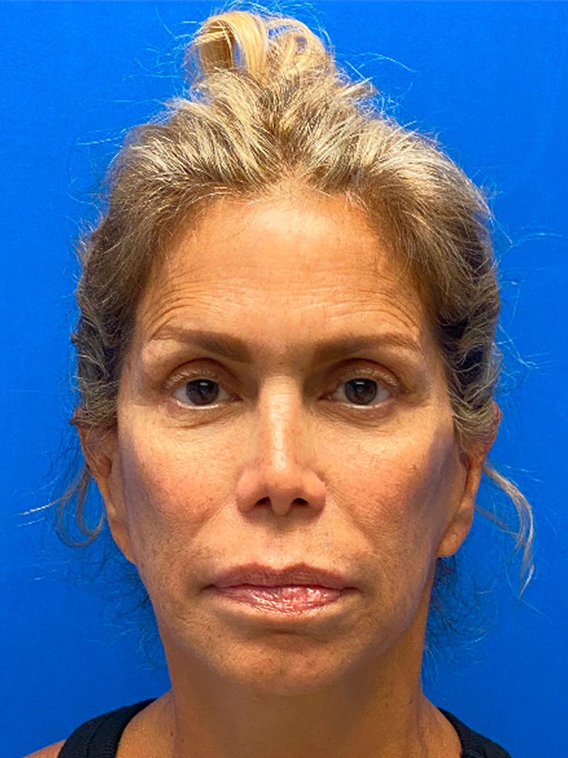Brow Lift  Before & After Gallery - Patient 140942 - Image 1