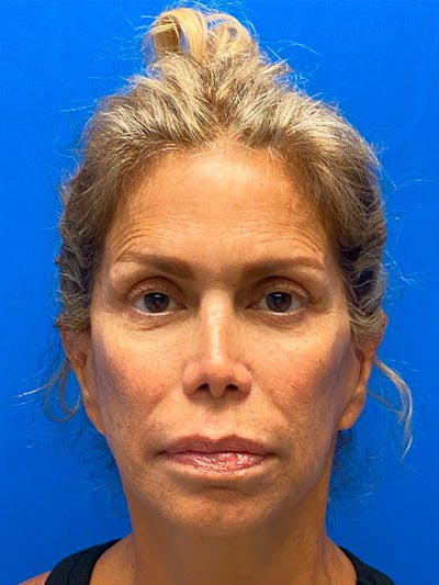 Facelift Before & After Gallery - Patient 214160 - Image 1