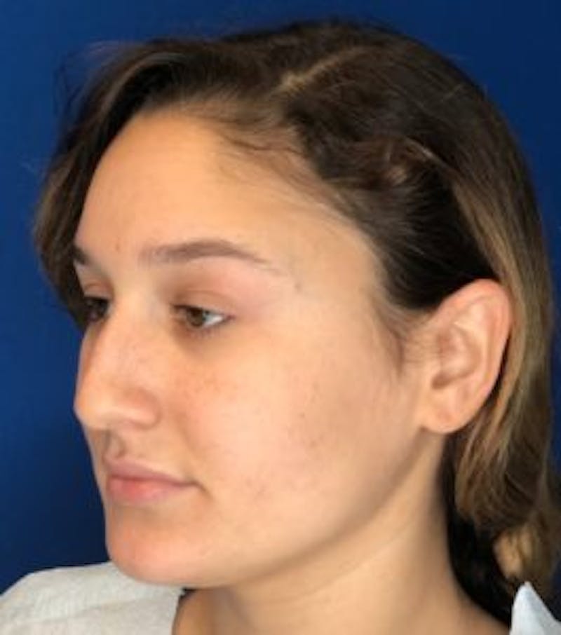 Primary Rhinoplasty Before & After Gallery - Patient 320169 - Image 15