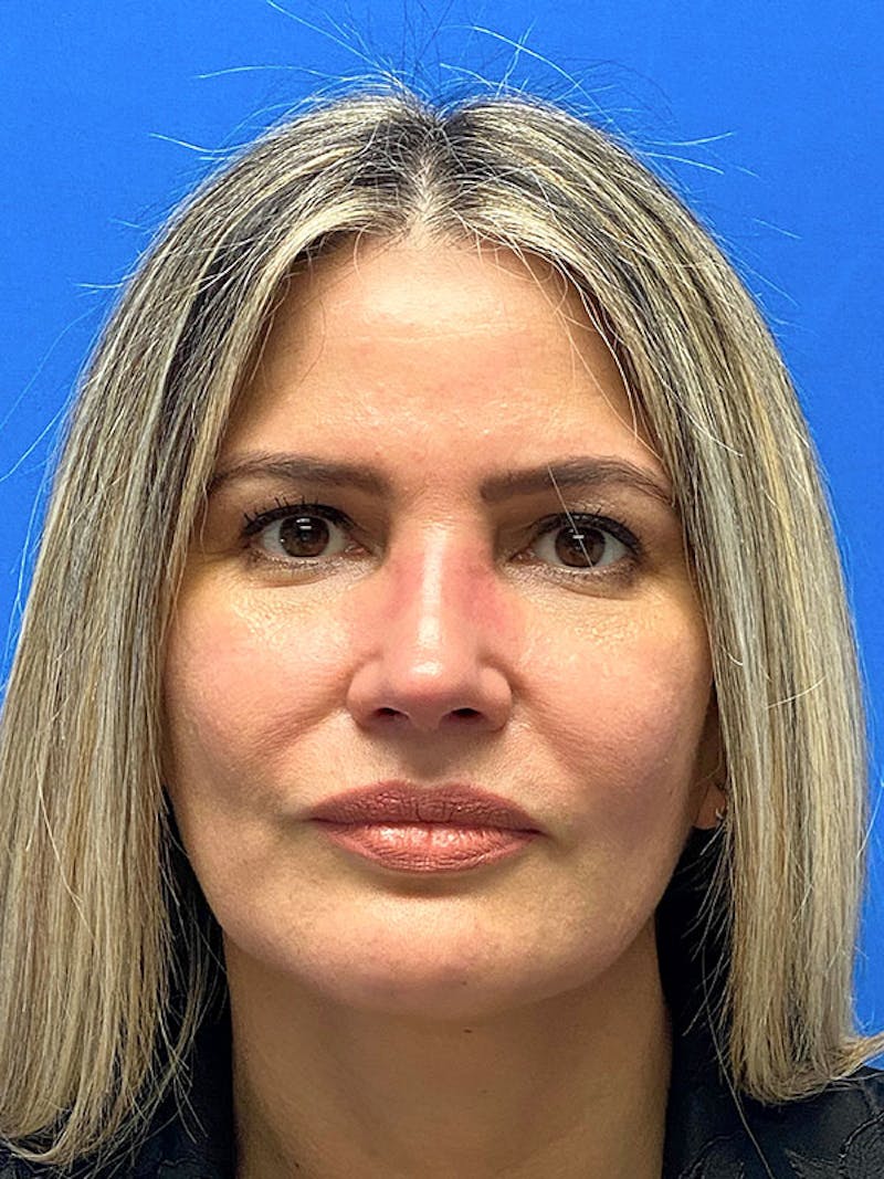 Revision Rhinoplasty Before & After Gallery - Patient 283261 - Image 4
