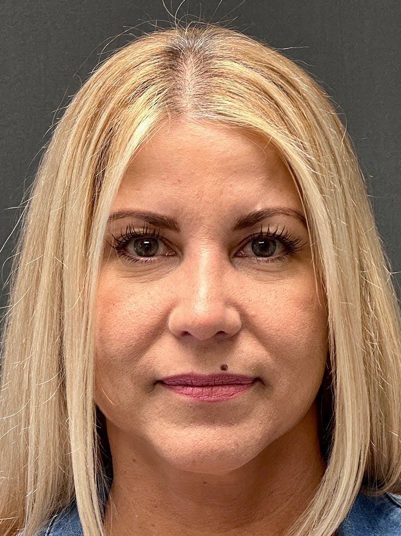 Primary Rhinoplasty Before & After Gallery - Patient 386694 - Image 4