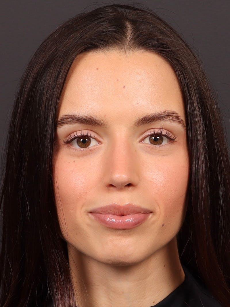 Primary Rhinoplasty Before & After Gallery - Patient 245621 - Image 4