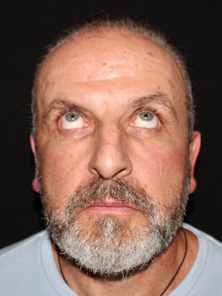 Blepharoplasty Before & After Gallery - Patient 669983 - Image 4