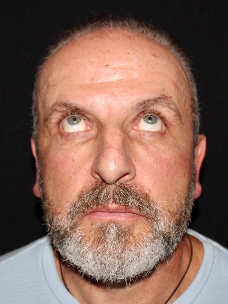 Blepharoplasty Before & After Gallery - Patient 669983 - Image 4