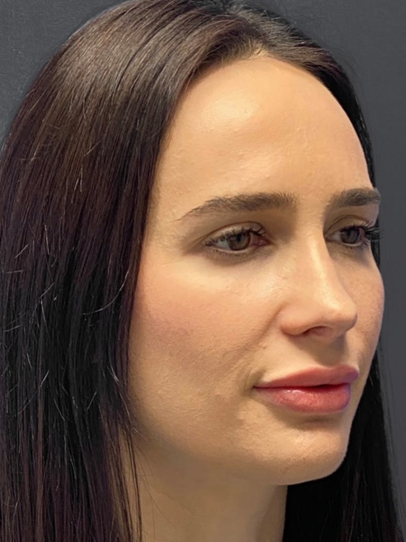 Revision Rhinoplasty Before & After Gallery - Patient 240059 - Image 6