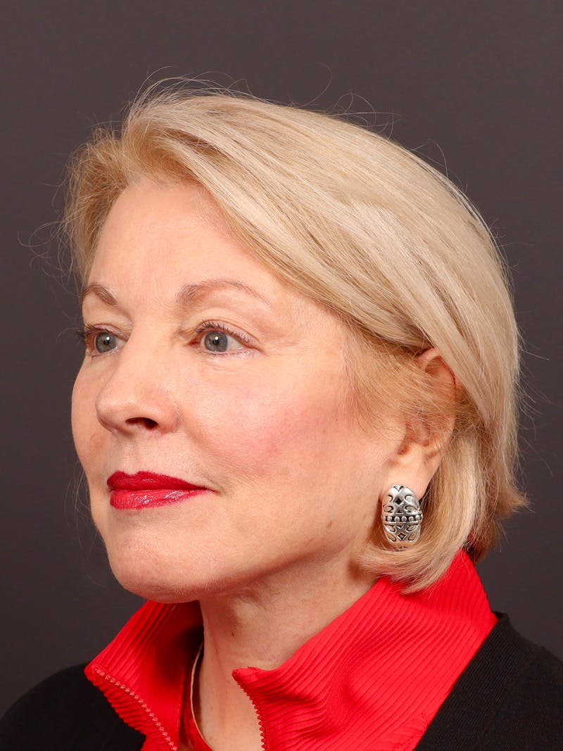 Facelift Before & After Gallery - Patient 119611 - Image 4
