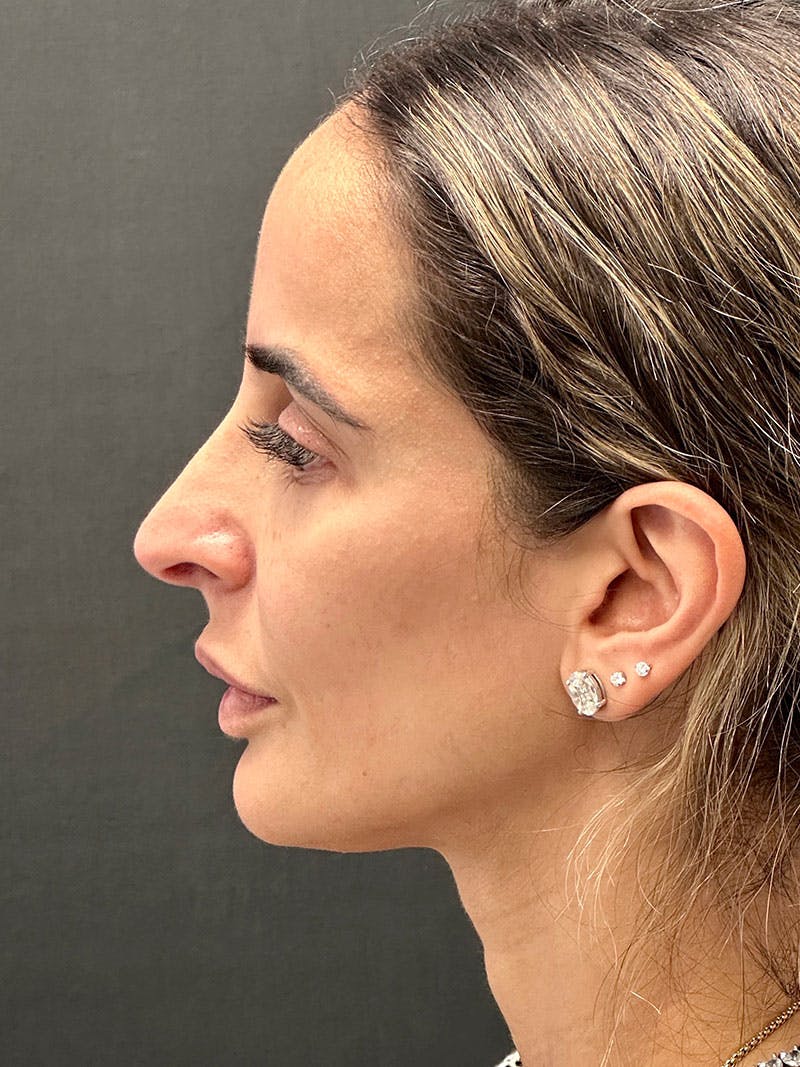 Brow Lift Before & After Gallery - Patient 183593 - Image 5