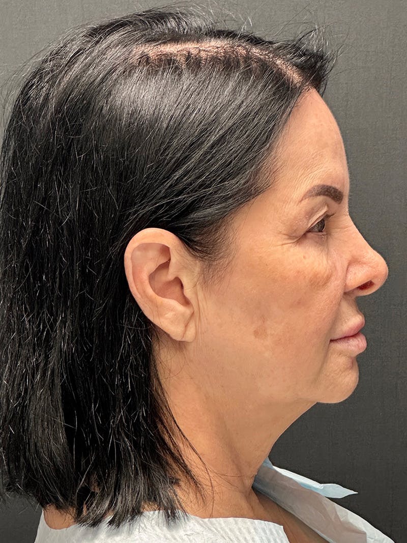 Facelift Before & After Gallery - Patient 358475 - Image 5
