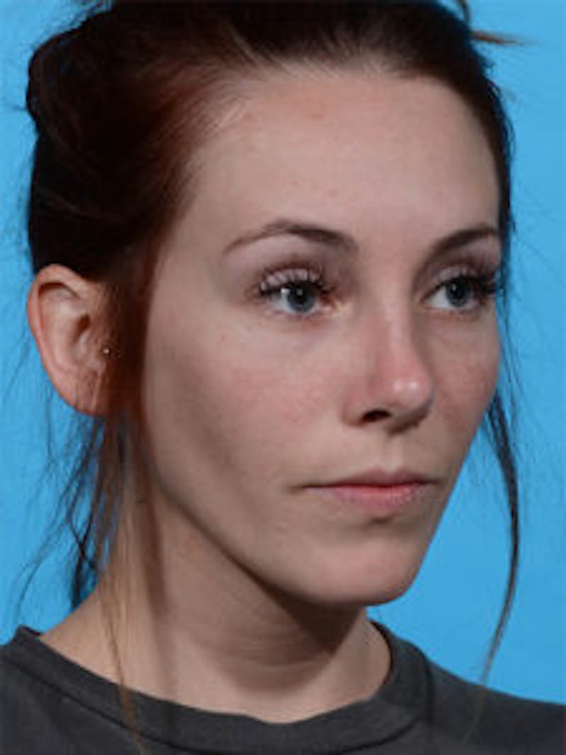 Primary Rhinoplasty Before & After Gallery - Patient 262137 - Image 2