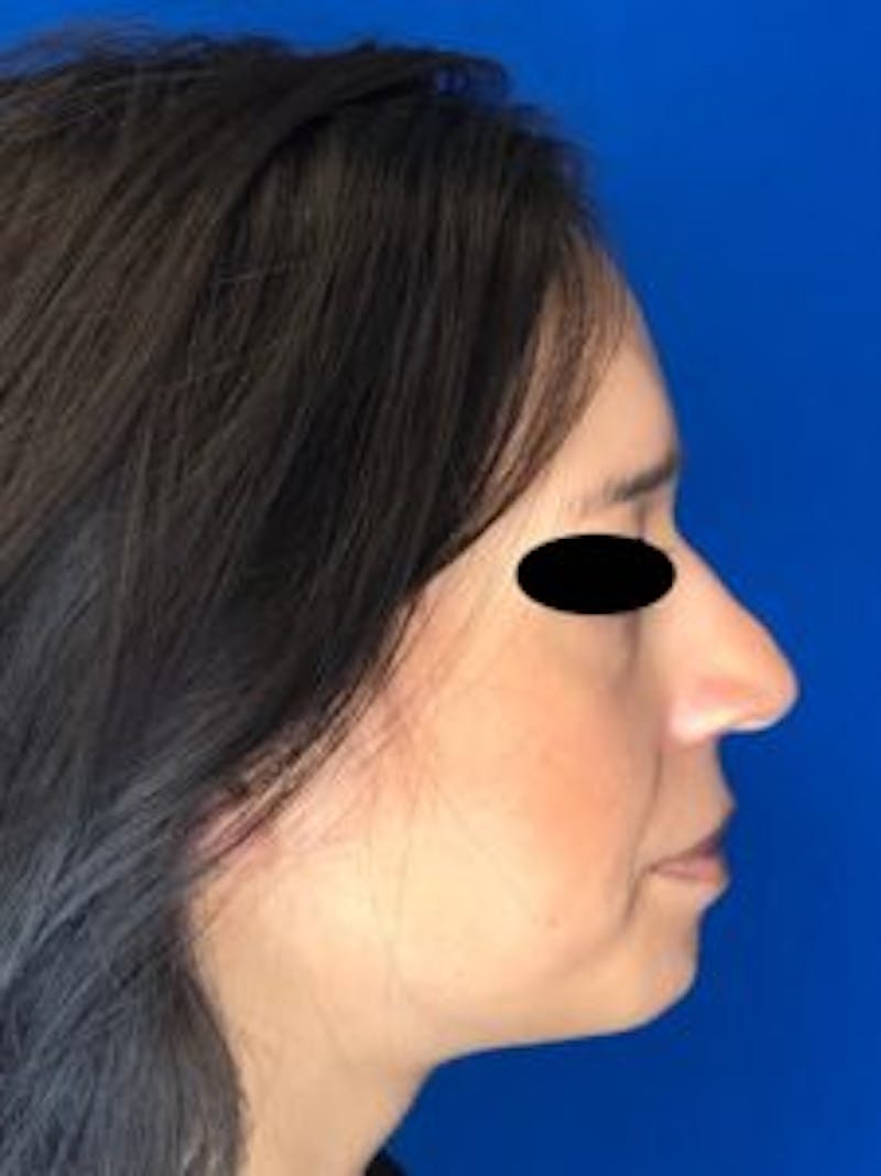 Primary Rhinoplasty Before & After Gallery - Patient 879608 - Image 1