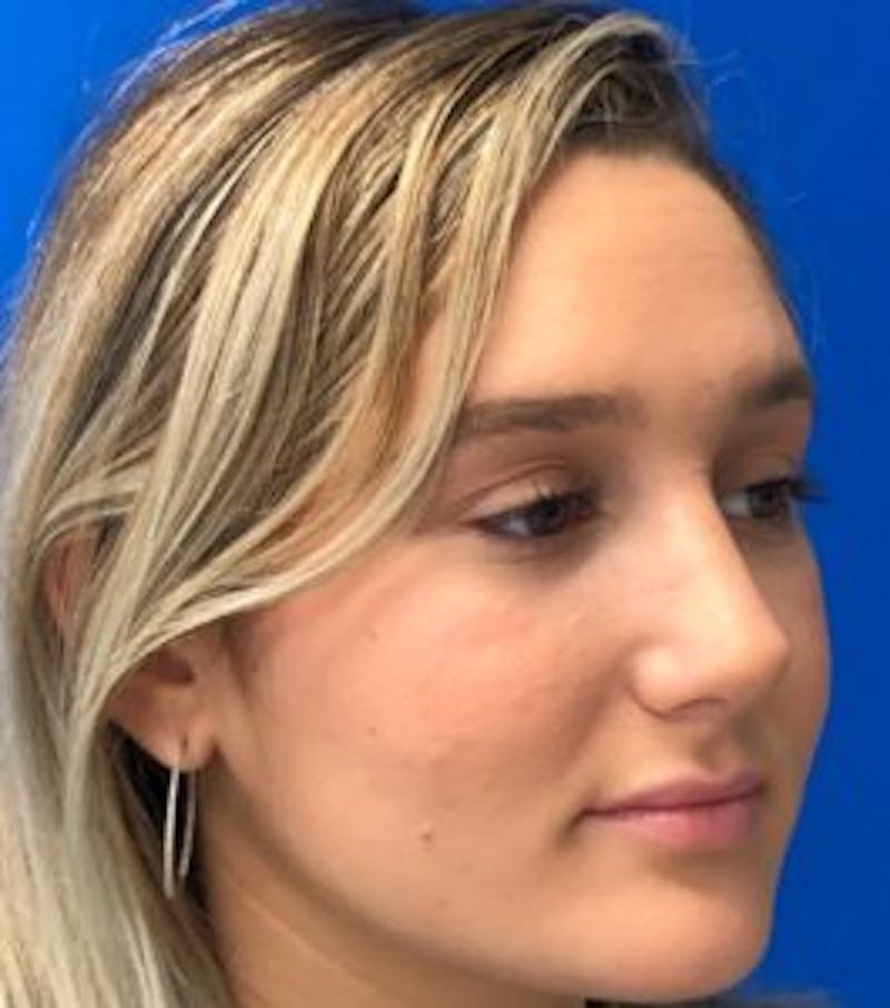 Primary Rhinoplasty Before & After Gallery - Patient 320169 - Image 8