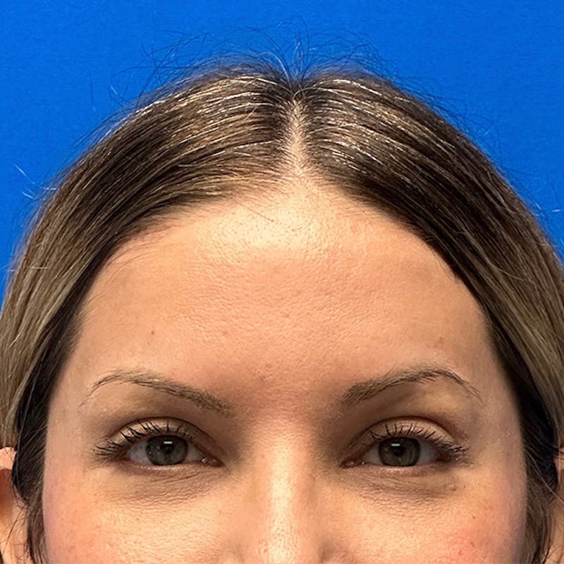 Blepharoplasty Before & After Gallery - Patient 580254 - Image 2