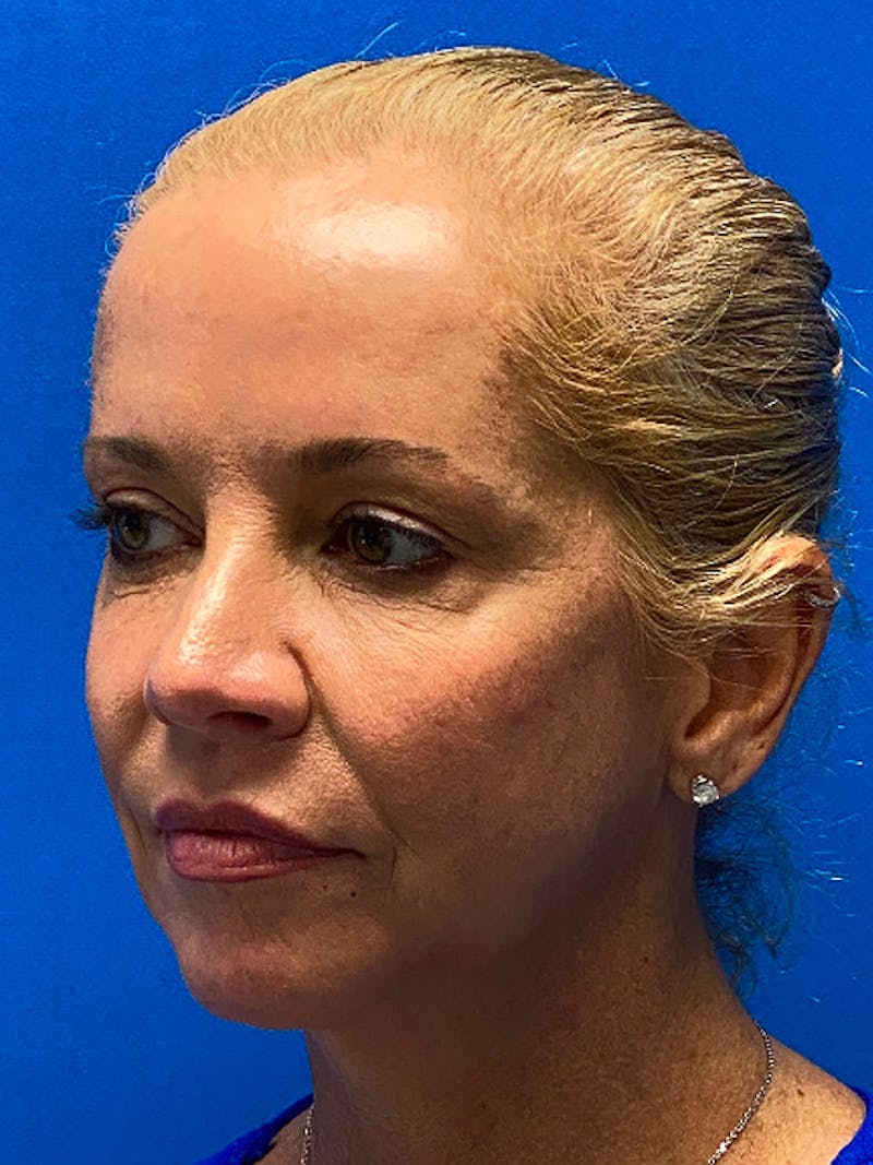 Facelift Before & After Gallery - Patient 298776 - Image 3