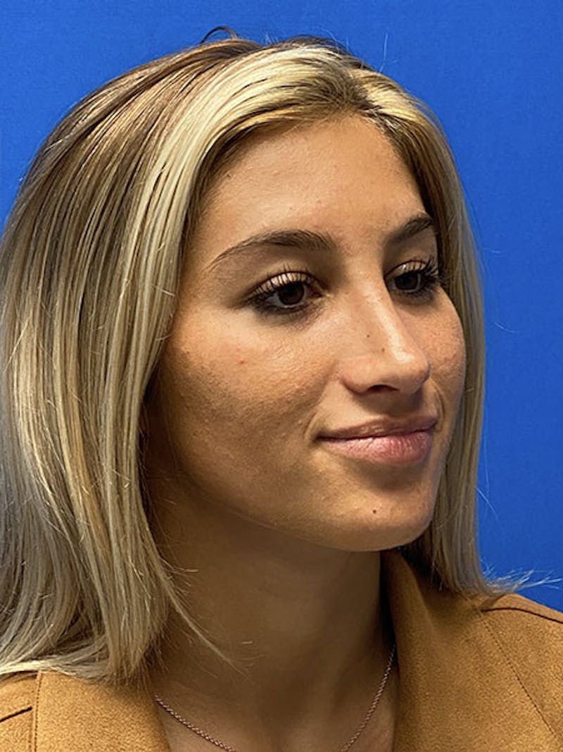 Primary Rhinoplasty Before & After Gallery - Patient 328366 - Image 6