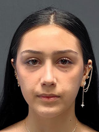 Primary Rhinoplasty Before & After Gallery - Patient 330004 - Image 4