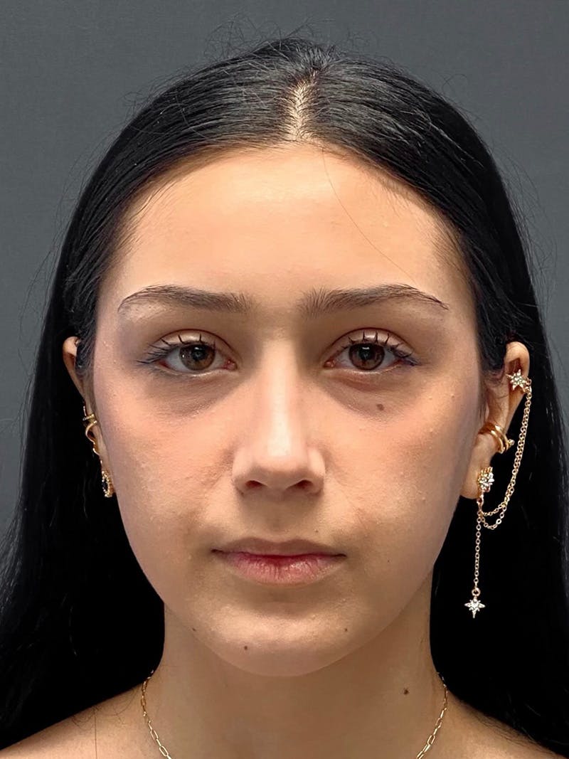 Primary Rhinoplasty Before & After Gallery - Patient 330004 - Image 4