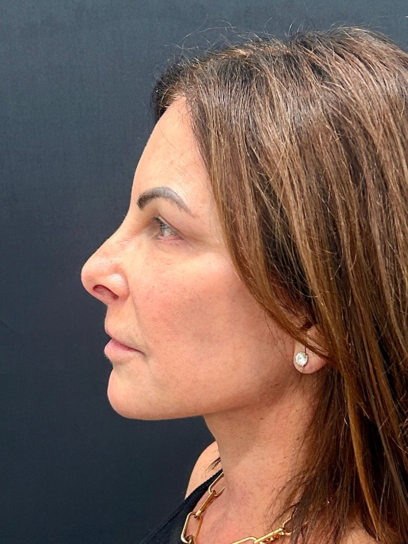 Brow Lift Before & After Gallery - Patient 349364 - Image 6
