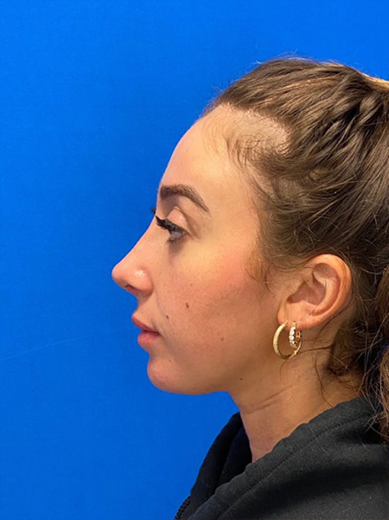 Primary Rhinoplasty Before & After Gallery - Patient 334537 - Image 6