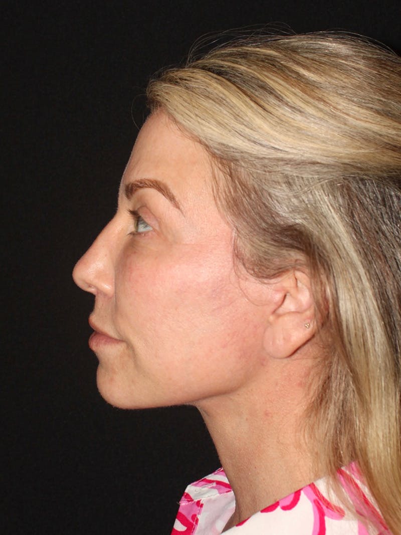 Facelift Before & After Gallery - Patient 420053 - Image 6