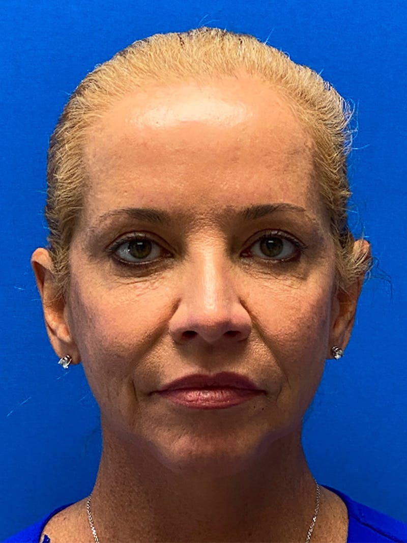 Facelift Before & After Gallery - Patient 298776 - Image 1