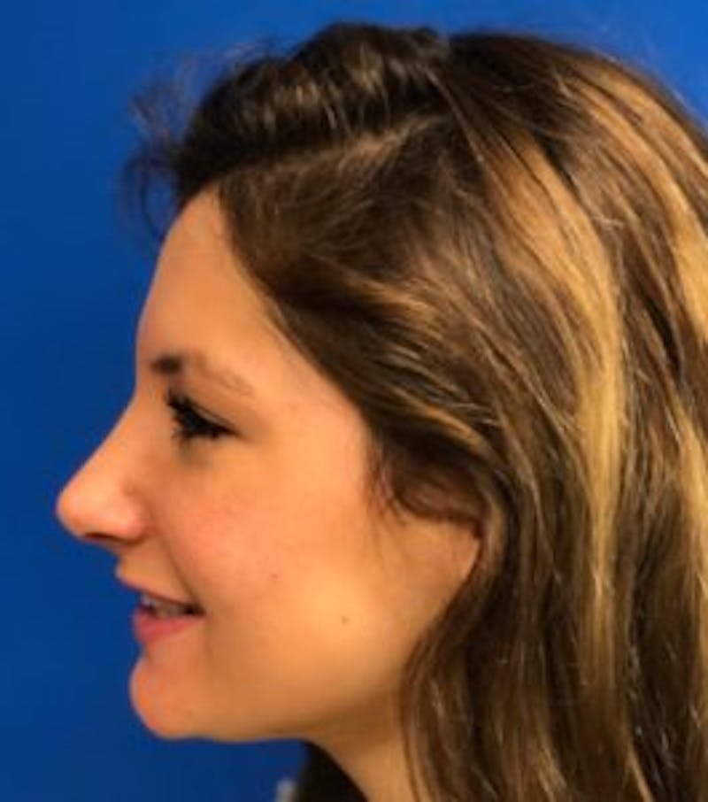 Primary Rhinoplasty Before & After Gallery - Patient 550195 - Image 14