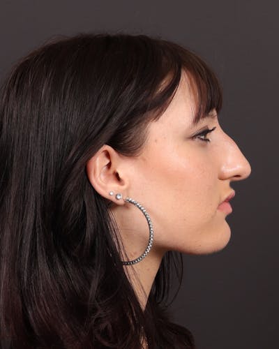 Primary Rhinoplasty Before & After Gallery - Patient 420494 - Image 1