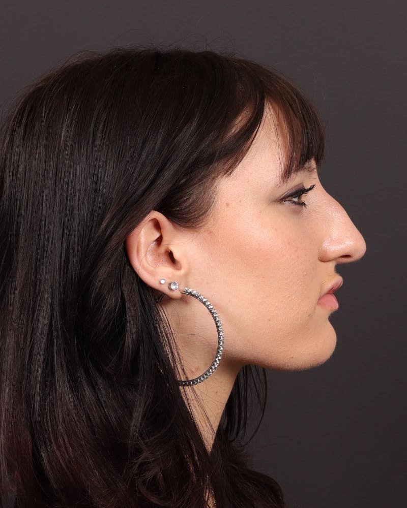 Primary Rhinoplasty Before & After Gallery - Patient 420494 - Image 1