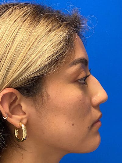 Primary Rhinoplasty Before & After Gallery - Patient 317021 - Image 1