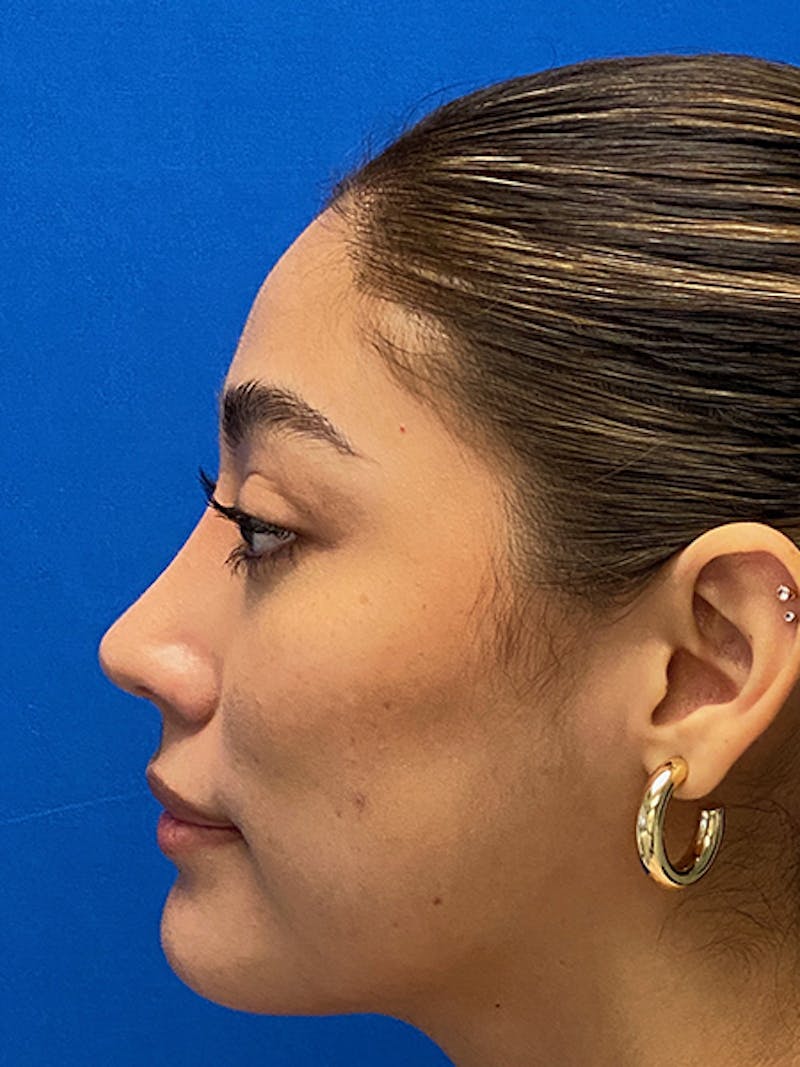 Primary Rhinoplasty Before & After Gallery - Patient 317021 - Image 8