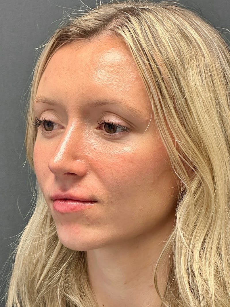Chin Augmentation Before & After Gallery - Patient 142902 - Image 6