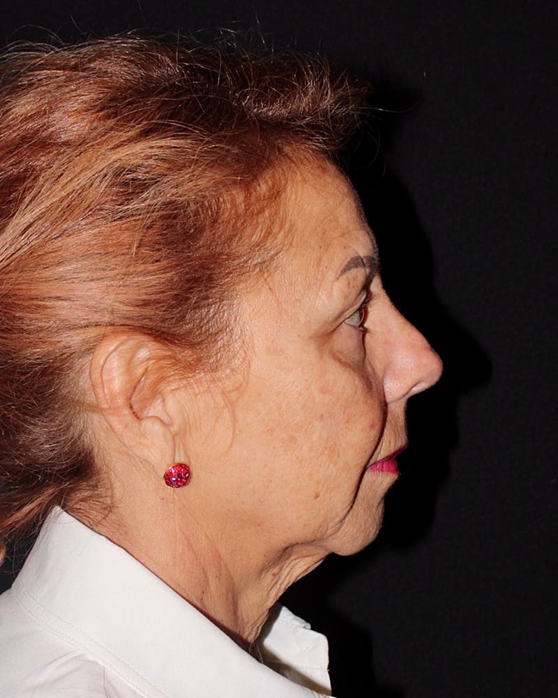 Facelift Before & After Gallery - Patient 304571 - Image 5