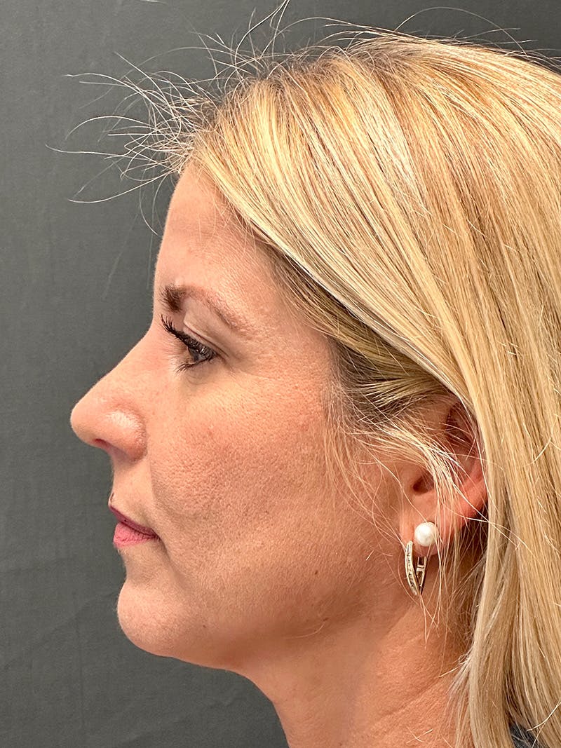 Primary Rhinoplasty Before & After Gallery - Patient 386694 - Image 2