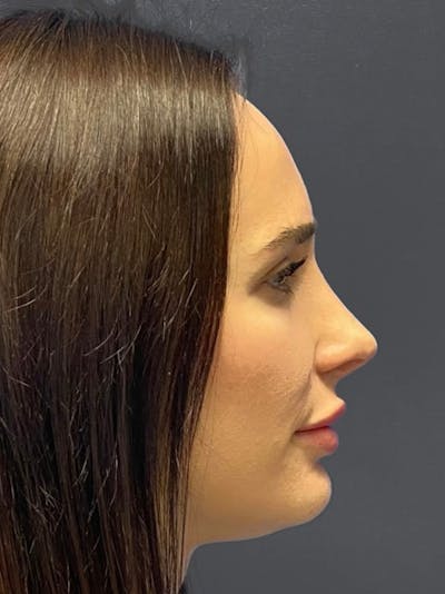 Revision Rhinoplasty Before & After Gallery - Patient 240059 - Image 2