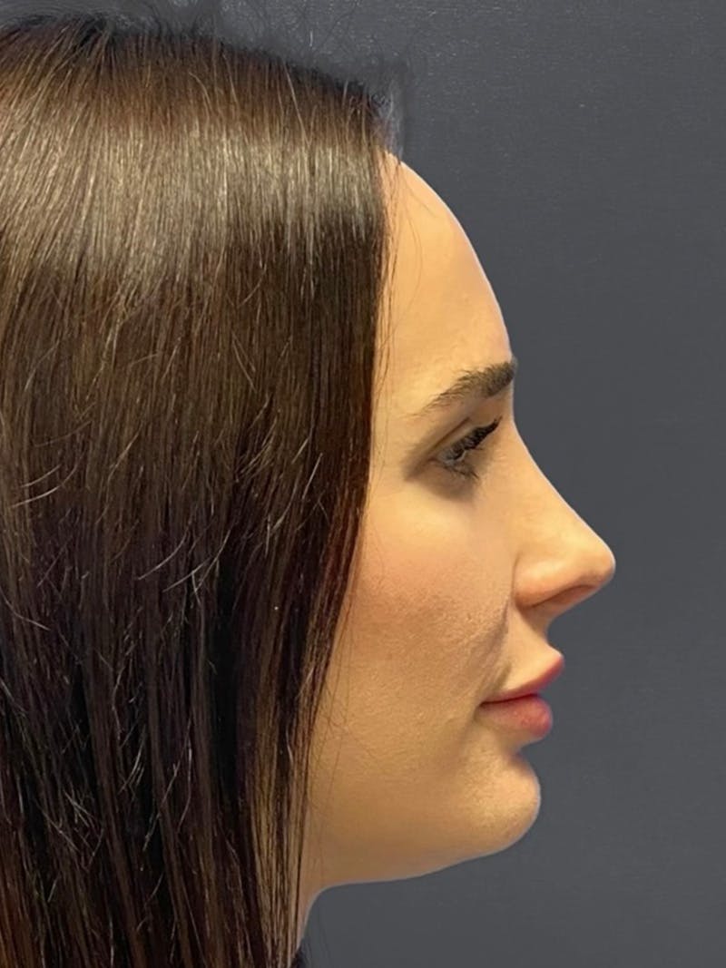 Revision Rhinoplasty Before & After Gallery - Patient 240059 - Image 2
