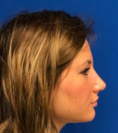 Primary Rhinoplasty Before & After Gallery - Patient 550195 - Image 2