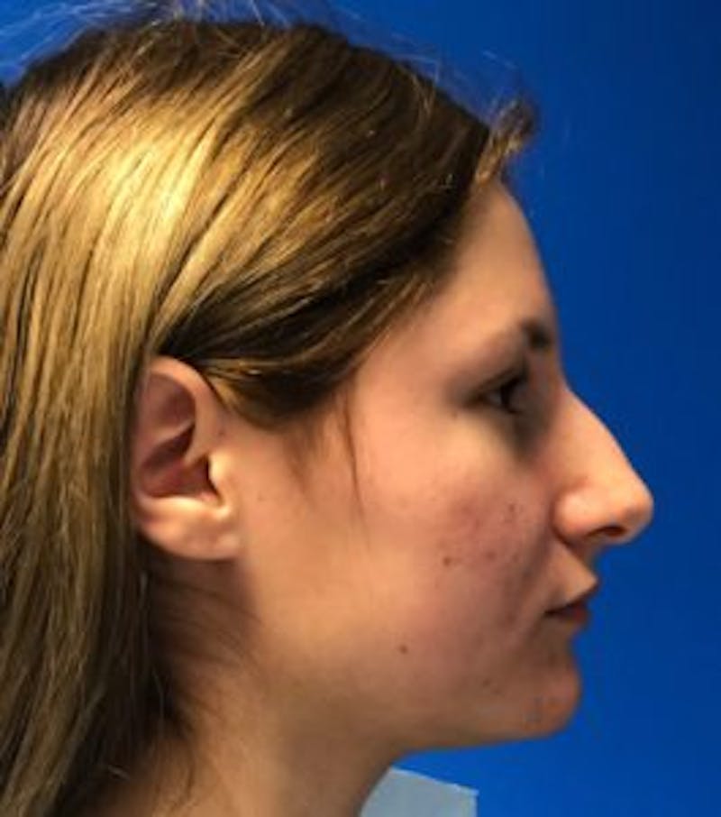 Primary Rhinoplasty Before & After Gallery - Patient 550195 - Image 1
