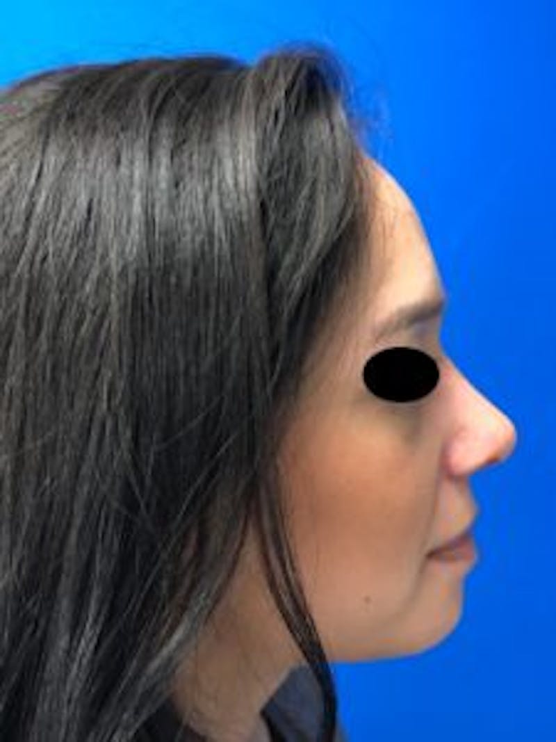 Primary Rhinoplasty Before & After Gallery - Patient 879608 - Image 2