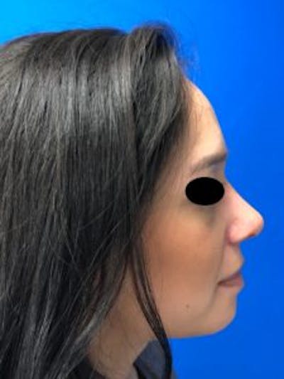 Primary Rhinoplasty Before & After Gallery - Patient 879608 - Image 2