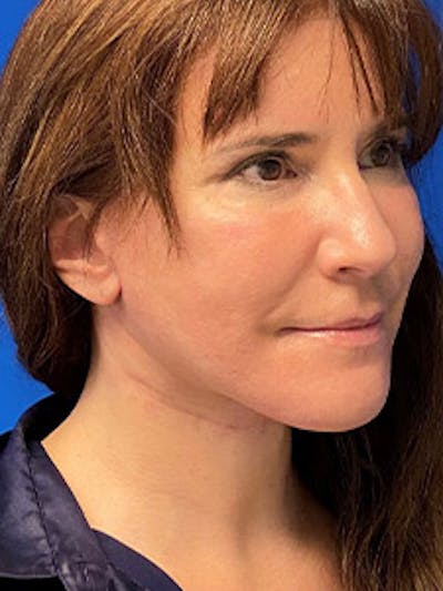 Facelift Before & After Gallery - Patient 327892 - Image 2