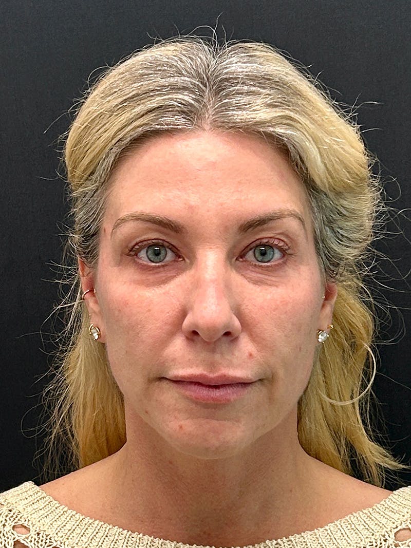 Facelift Before & After Gallery - Patient 420053 - Image 1
