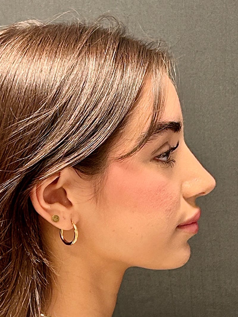 Primary Rhinoplasty Before & After Gallery - Patient 339573 - Image 2